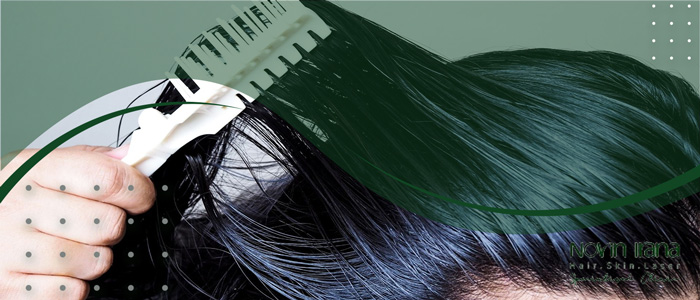 عوامل تفاقم دهون فروة الرأس بعد زراعة الشعر