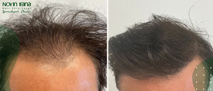 الرعاية طويلة المدى بعد زراعة الشعر