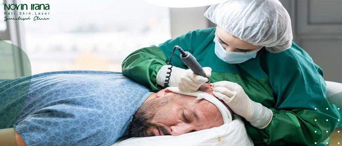 لماذا يمكن أن تكون زراعة الشعر عند كبار السن مشكلة؟
