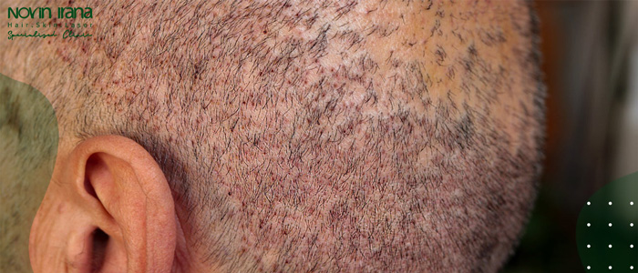 أبرز مميزات زراعة الشعر بدون حلاقة للنساء والرجال