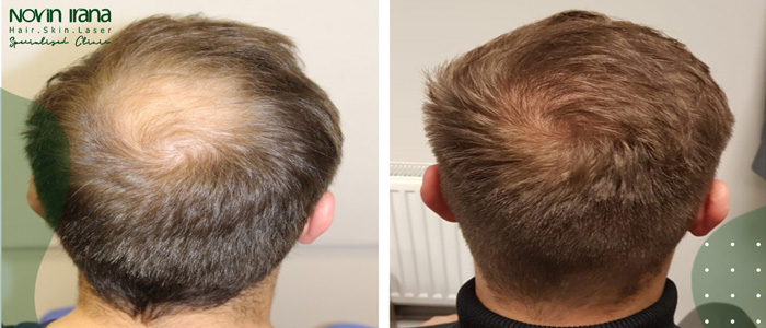 هل يمكن للإناث اللجوء لزراعة الشعر دون حلاقة