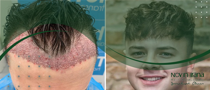ماذا يحدث بعد 10 سنوات من زراعة الشعر
