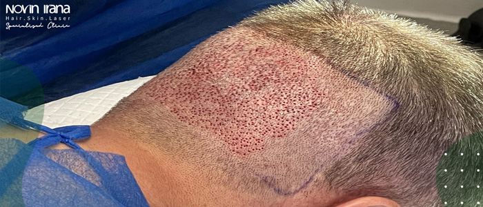 سن زراعة الشعر