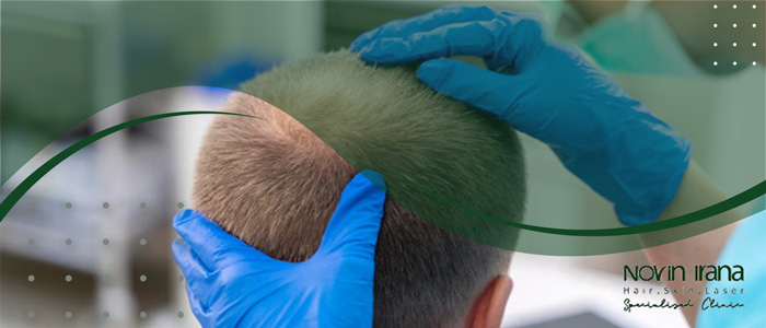 الرعاية بعد زراعة الشعر
