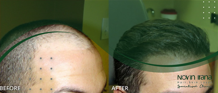أهمية رعاية ما بعد زراعة الشعر