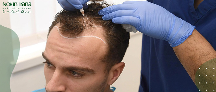 هل يمكن إجراء زراعة الشعر في أي عمر؟