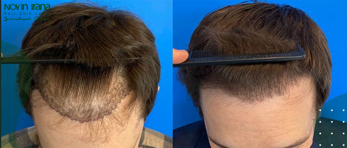 كم تستغرق عملية زراعة الشعر؟