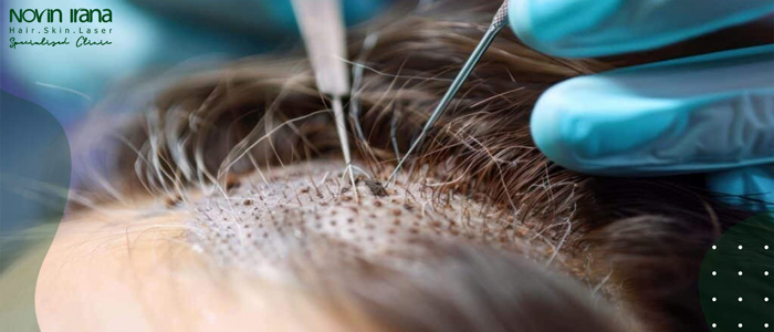 لماذا قد تواجه زراعة الشعر في سن مبكرة مشاكل؟
