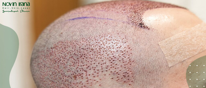 زراعة الشعر بدون حلاقة