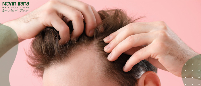 افضل وقت لزراعة الشعر