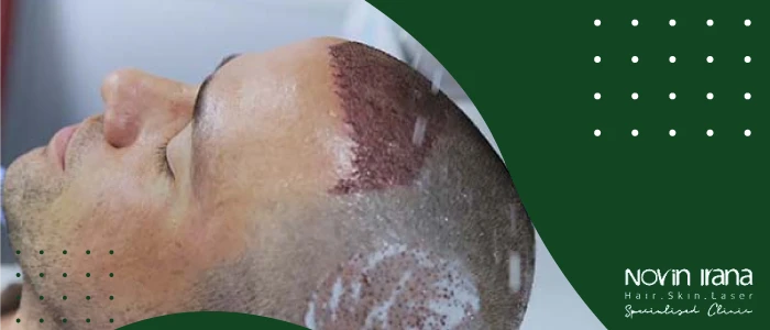 پیشگیری از خونریزی بعد از کاشت مو