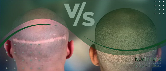 مزايا زراعة الشعر بطريقة FUE