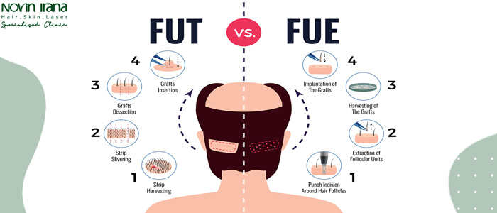عيوب زراعة الشعر بطريقة FUE
