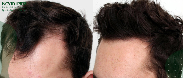 ما هي زراعة الشعر بطريقة FUT؟