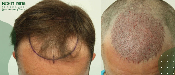 تطبيقات زراعة الشعر بطريقة FUT