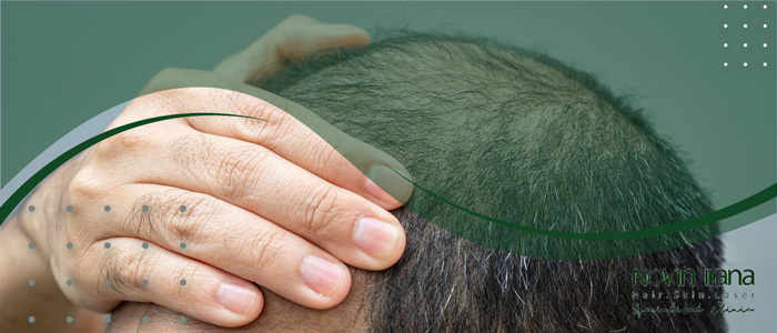 الرعاية قبل وبعد زراعة الشعر