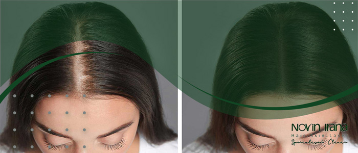 المخاطر والمضاعفات المحتملة زراعة الشعر