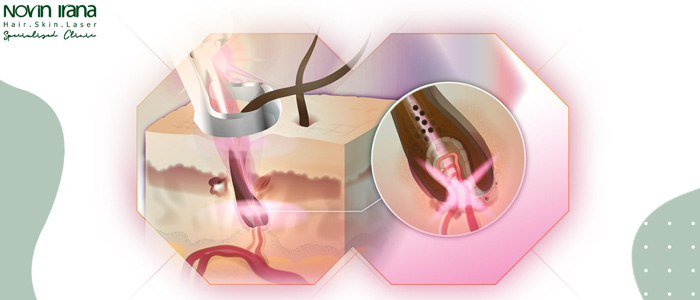 راهکارهای افزایش عمر الکساندرایت