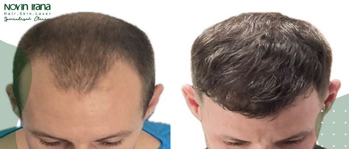 من هم الأشخاص غير المناسبين لزراعة الشعر بطريقة FUT؟