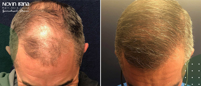مراحل زراعة الشعر بطريقة FUT