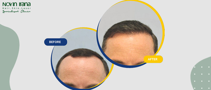 جایگزین های کاشت مو چیست؟