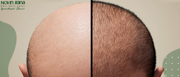 من هم الأشخاص المناسبون لزراعة الشعر بطريقة FUT؟