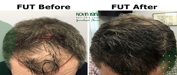مميزات وعيوب زراعة الشعر بطريقة FUT