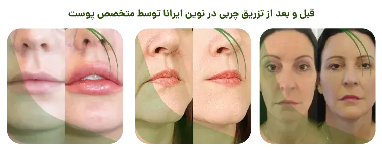 قبل و بعد از تزریق چربی در نوین ایرانا مشهد
