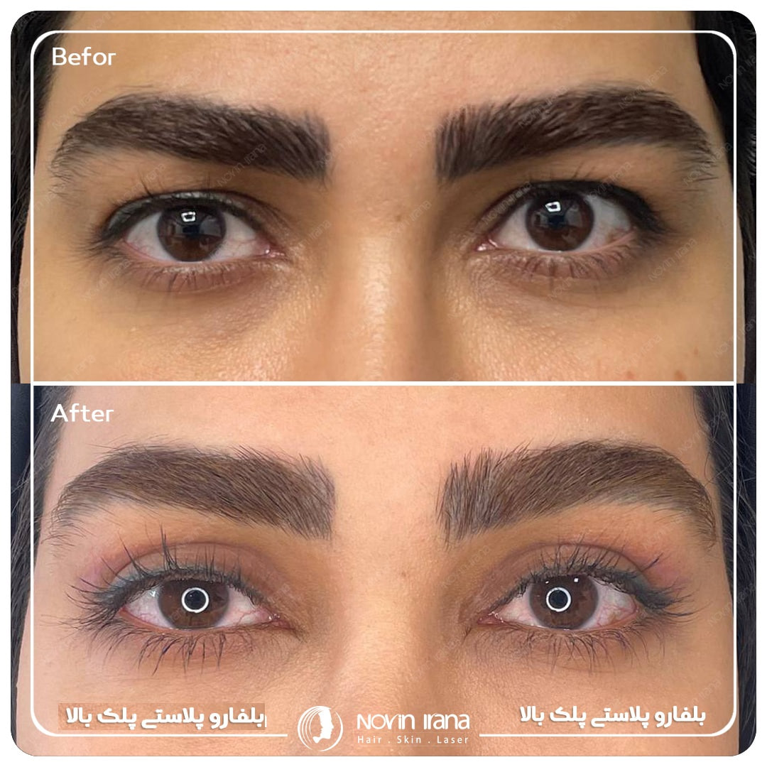 نمونه بلفاروپلاستی