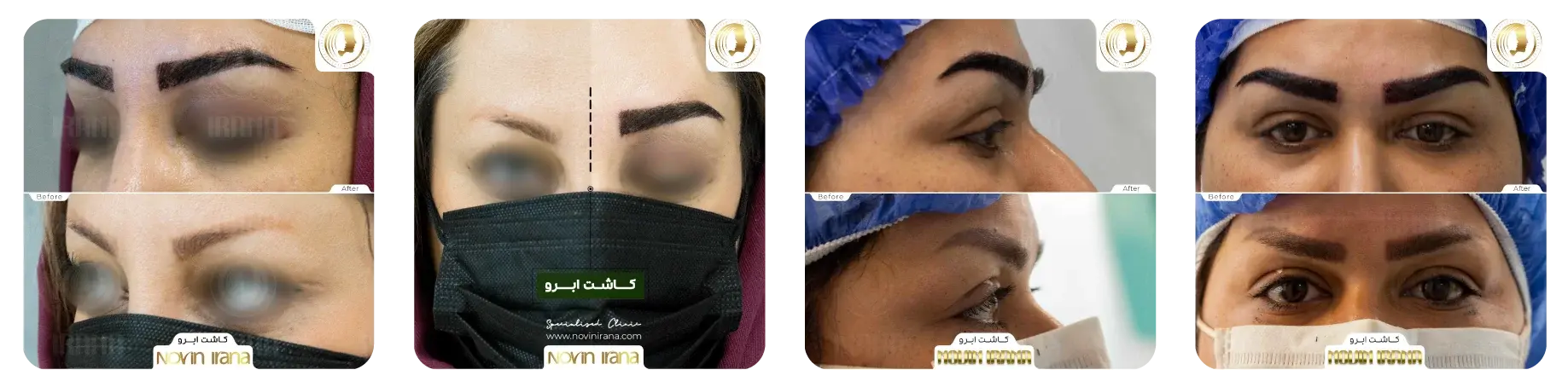 عکس های قبل و بعد کاشت ابرو در نوین ایرانا