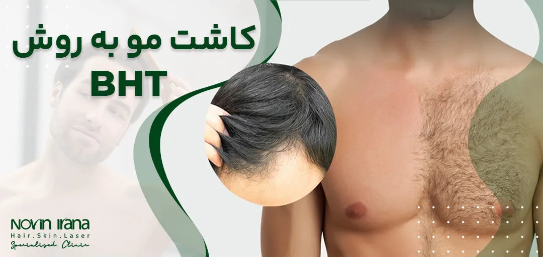 کاشت مو به روش BHT