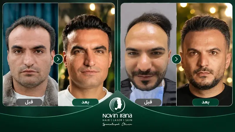 تصاویر قبل و بعد کاشتن مو در مرکز نوین ایرانا