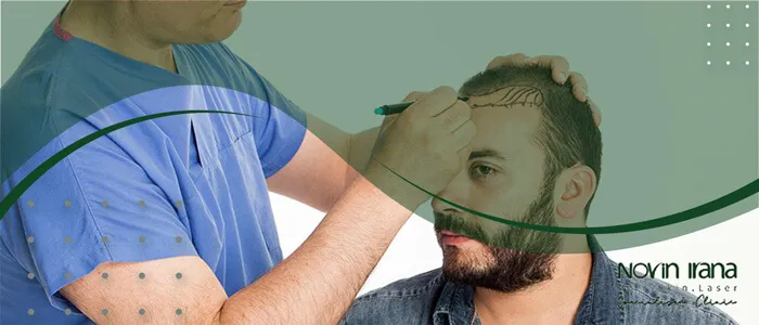 چه کسانی کاندیدهای مناسب کاشت مو هستند؟