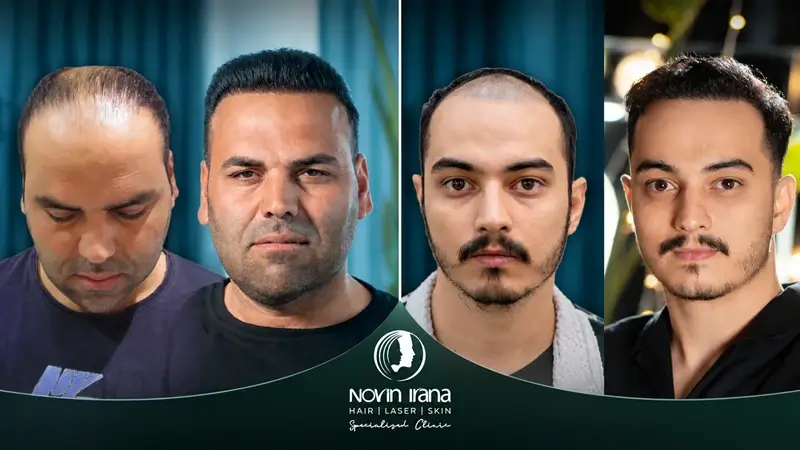 تصاویر قبل و بعد کاشت مو در مرکز نوین ایرانا