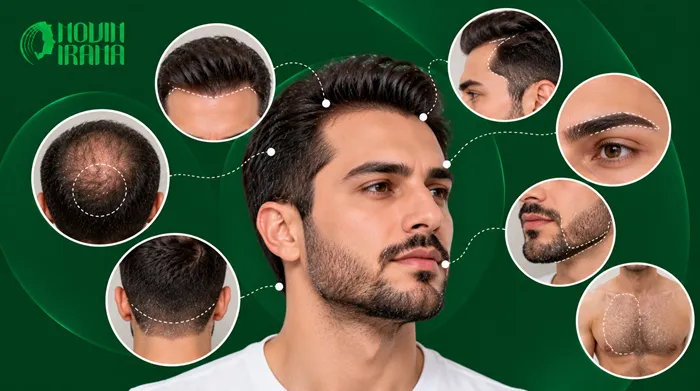 کاشت موی در چه قسمت هایی انجام می شود؟