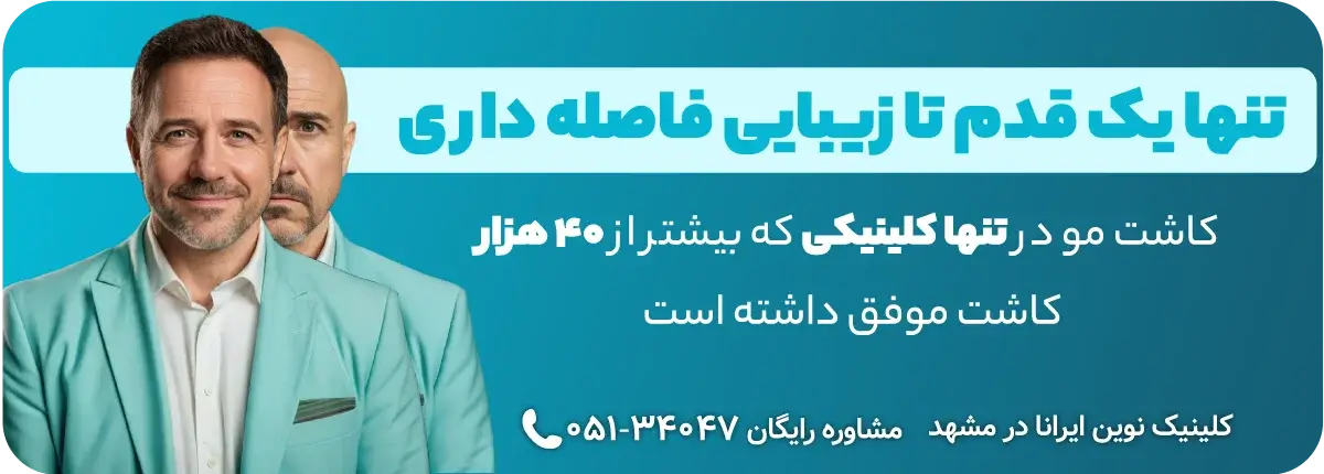 کاشتن موهای سر با خدمات ویژه