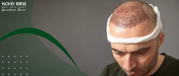 کاشت مو به روش FUE