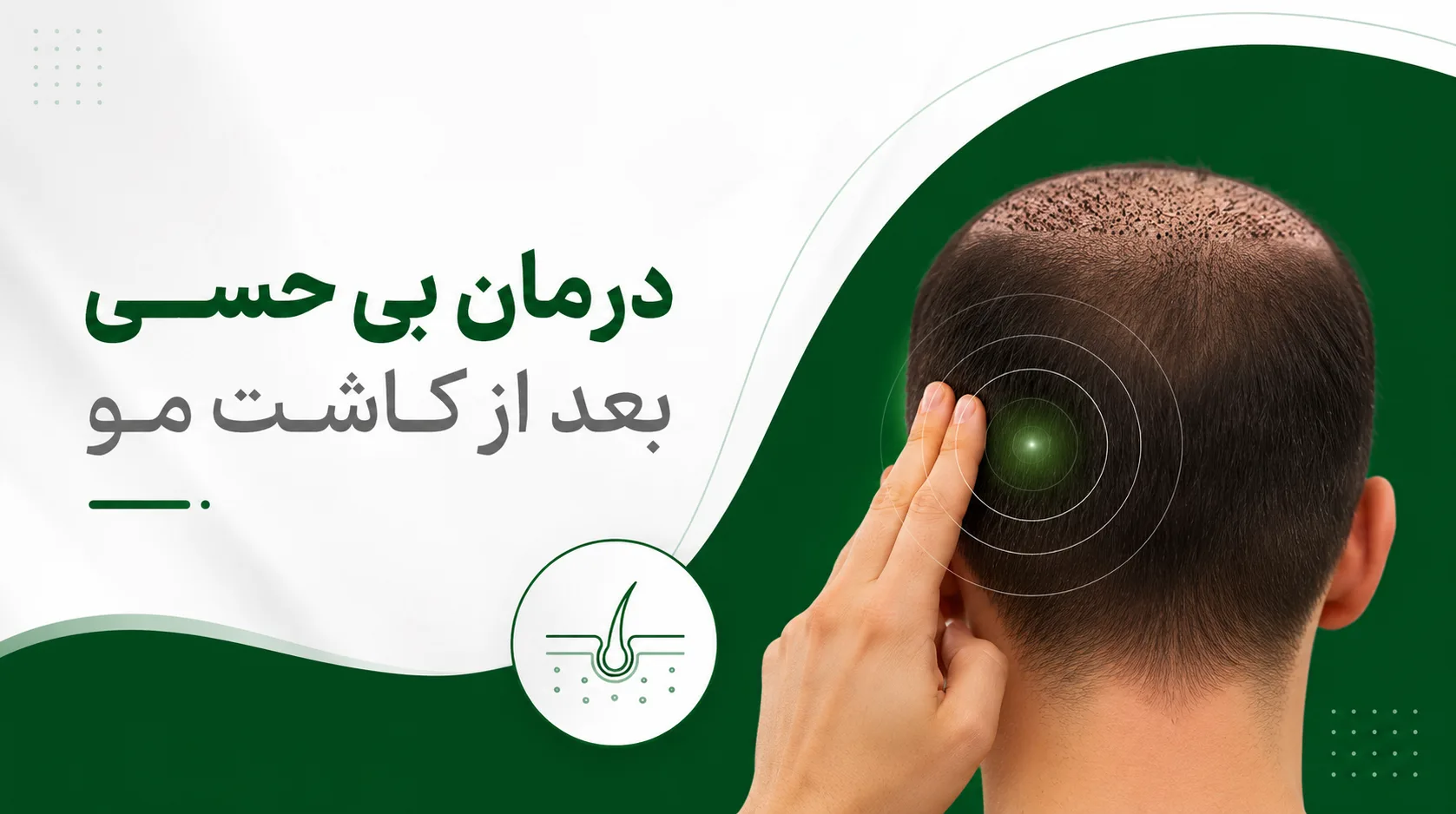 درمان بی حسی سر بعد از کاشت مو
