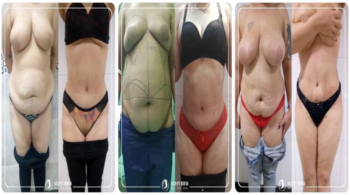 صور قبل وبعد نحت الجسم في ايران