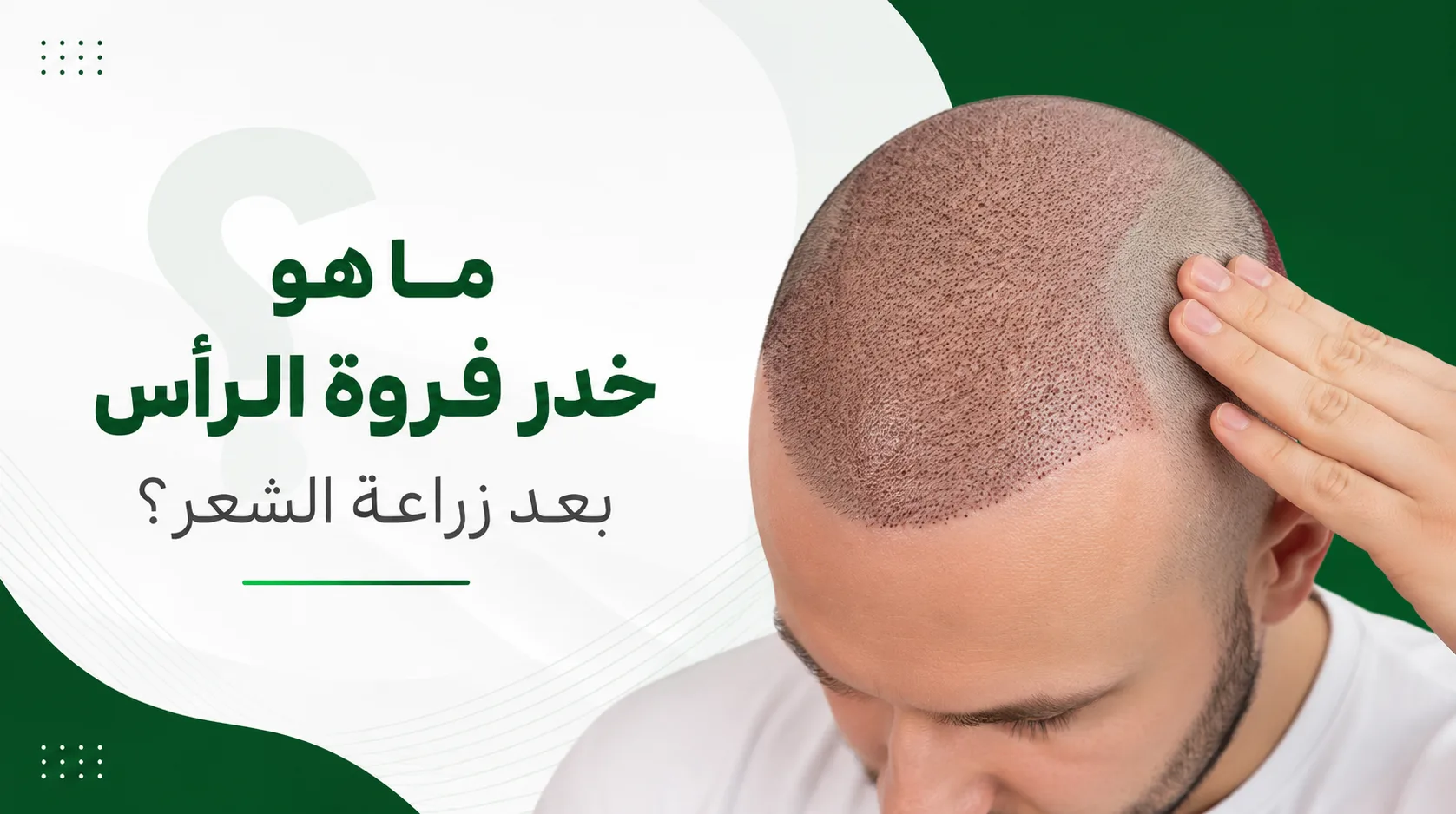 ما هو خدر فروة الرأس بعد زراعة الشعر؟