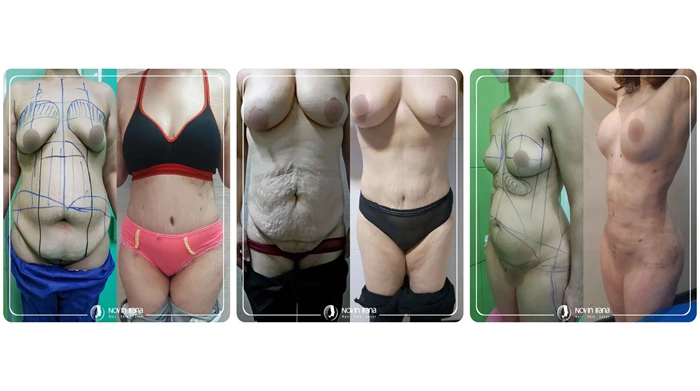 صور قبل وبعد افضل مركز شفط الدهون ايران