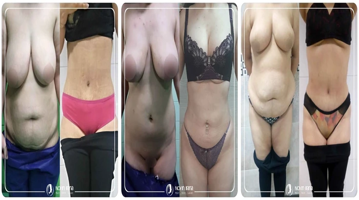 صور قبل وبعد عمليات شفط الدهون في ايران