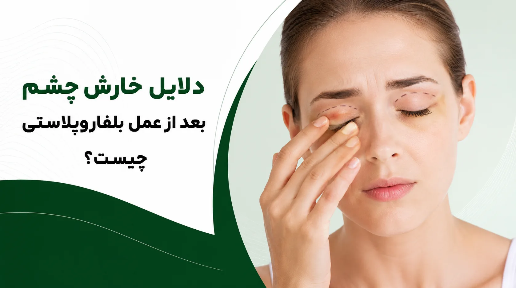 دلایل خارش چشم بعد از عمل بلفاروپلاستی چیست؟