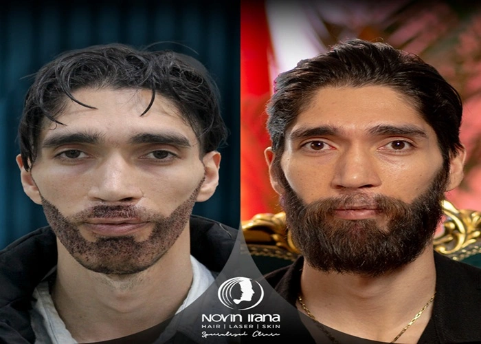 نتیجه کاشت ریش در کلینیک نوین ایرنا مشهد