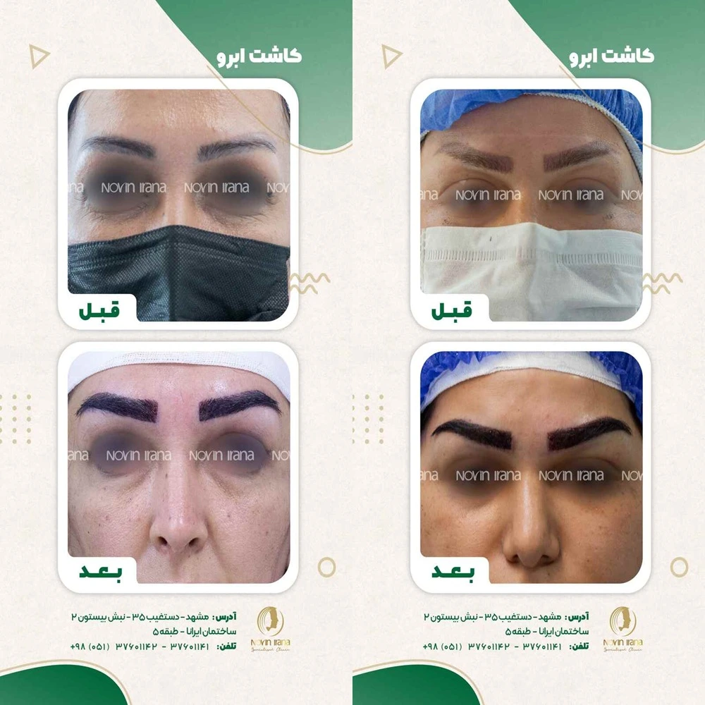 قبل و بعد کاشت ابرو مشهد