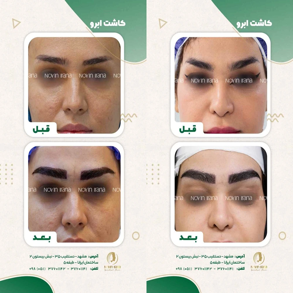 نتیجه قبل و بعد کاشت ابرو در کلینیک نوین ایرانا مشهد