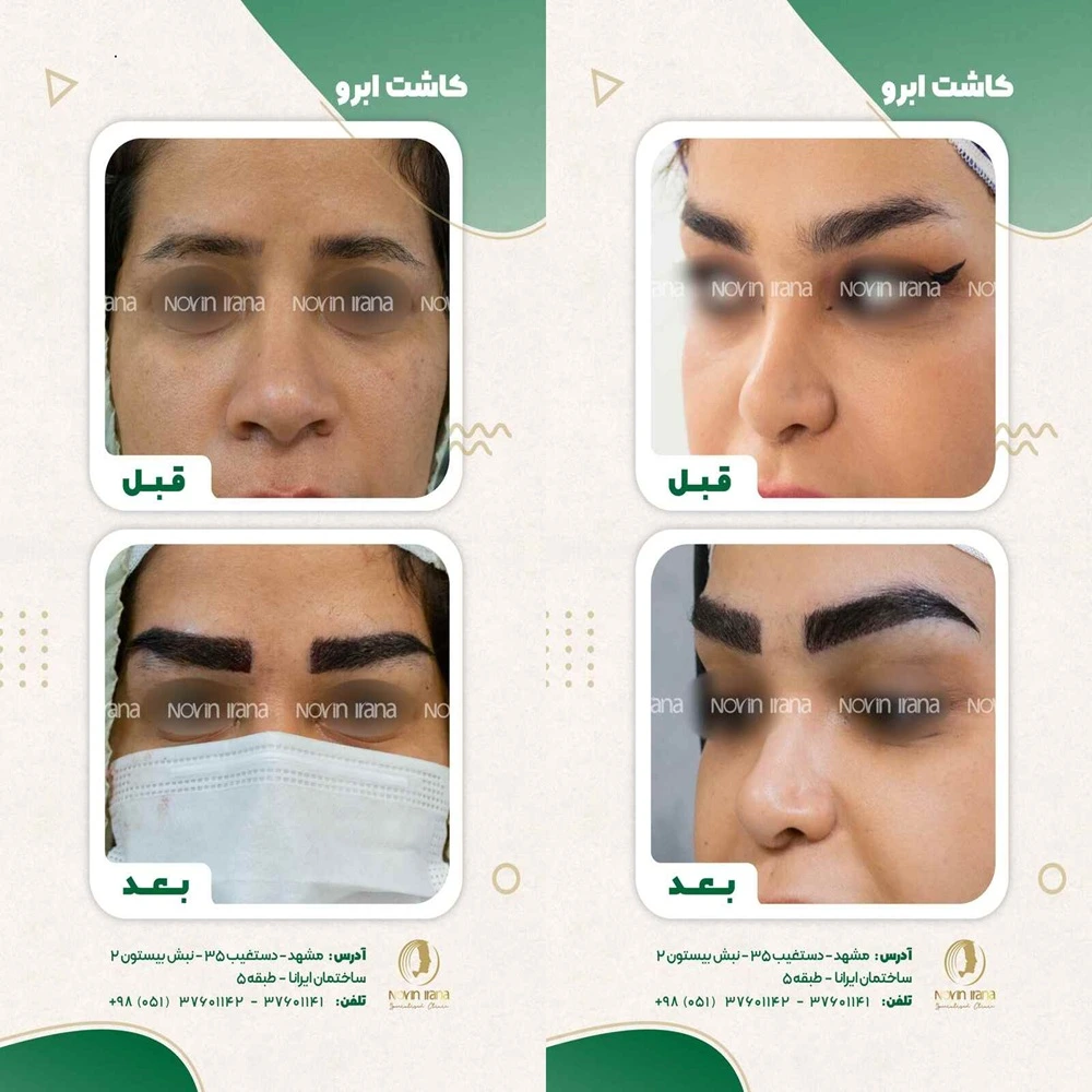 نتیجه قبل و بعد کاشت ابرو در مشهد