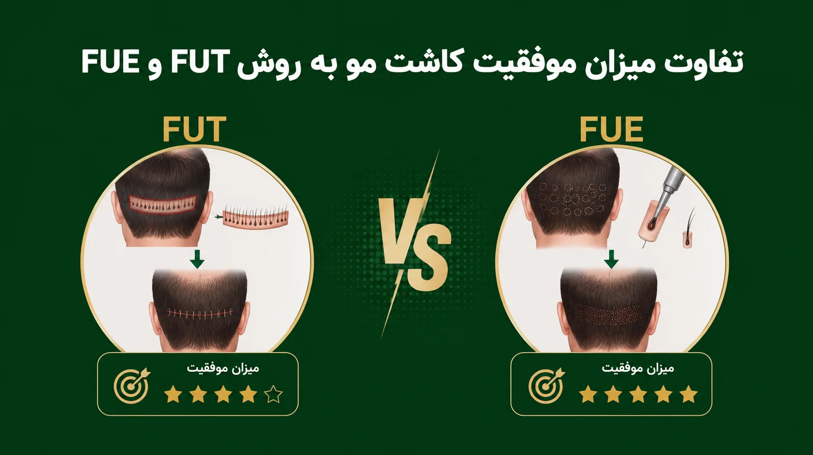 تفاوت میزان موفقیت کاشت مو به روش FUT و FUE