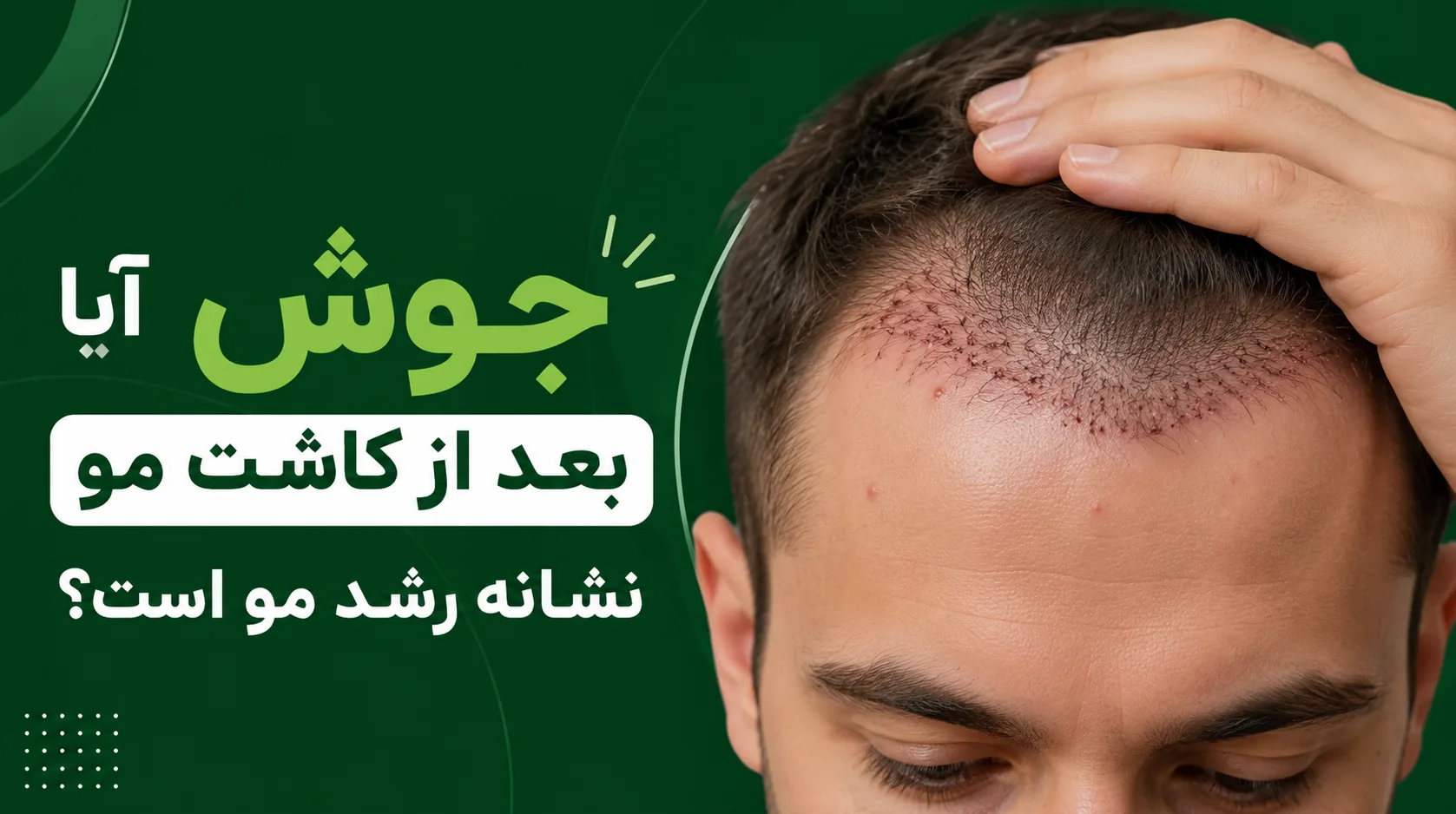 آیا جوش بعد از کاشت مو نشانه رشد مو است؟