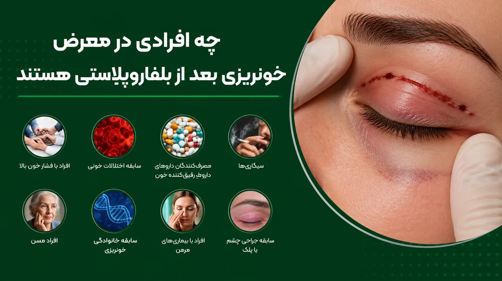 چه افرادی بیشتر در معرض خونریزی بعد از بلفاروپلاستی هستند